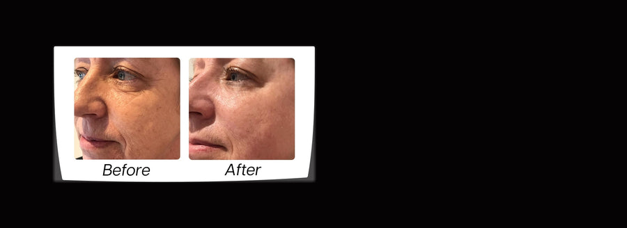 Non-surgical facelift