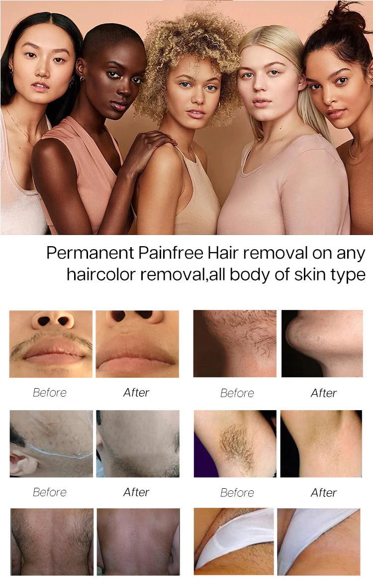 Winkonlaser AresLite DM60 Diode Laser Hair Removal Machine